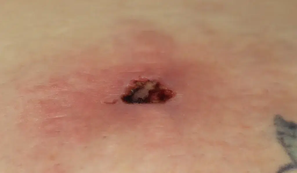 Brown Recluse Bite